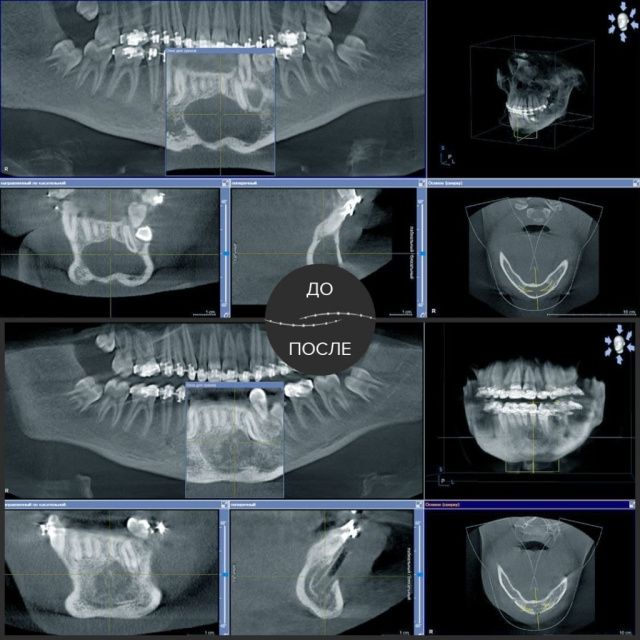 У пациента кератокиста подбородочного отдела нижней челюсти. 