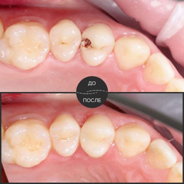 Лечение глубокого кариеса и реставрация зубной коронки.
