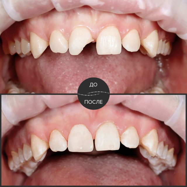 Восстановления скола зуба после травмы.
