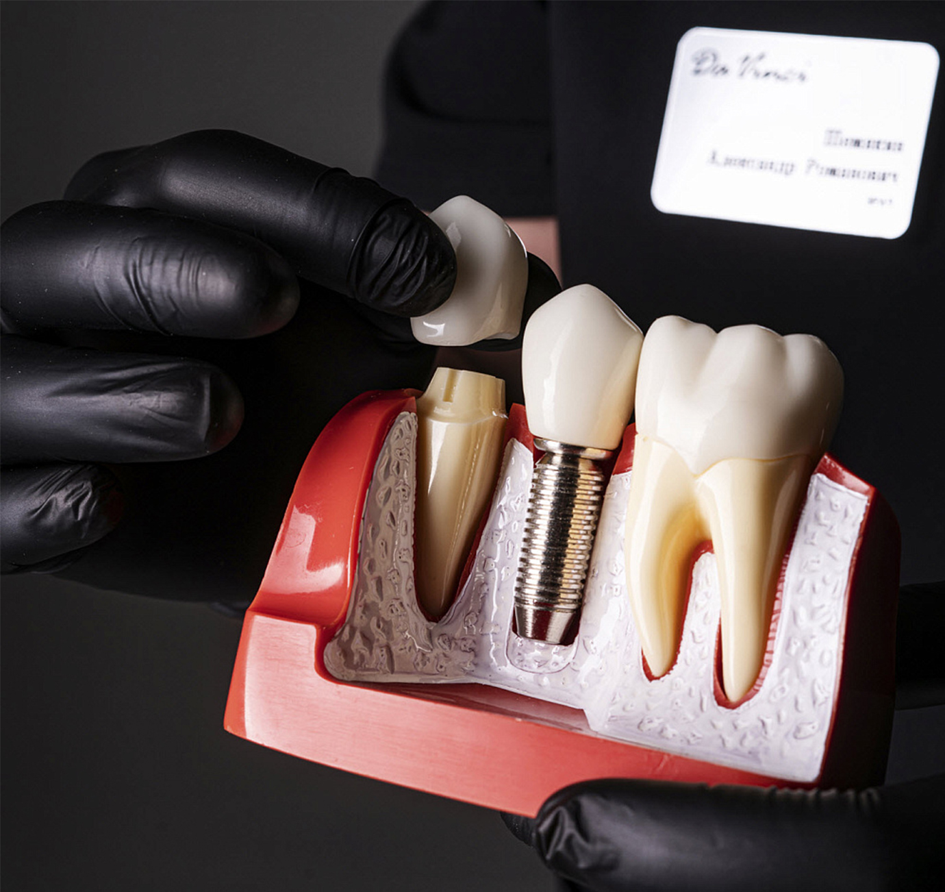 Имплантация зубов — новый уровень уверенности и комфорта