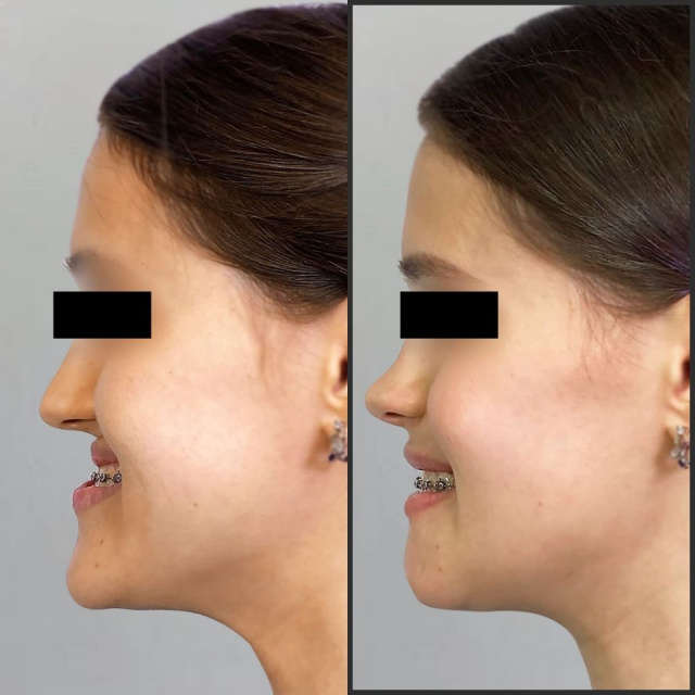 У пациентки СЗЧЛА — сочетанная зубочелюстно-лицевая аномалия, мезиальный прикус, асимметричное положение челюстей.
