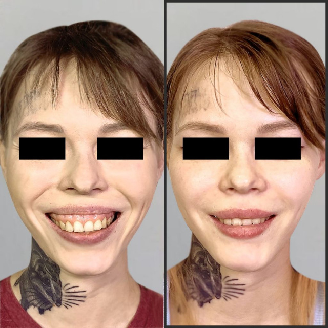 У пациентки асимметричная деформация челюстей, десневая улыбка, микрогнатия.
