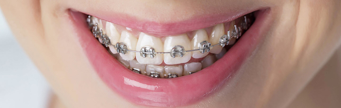 Сколько времени нужно носить брекеты — и можно ли сократить срок