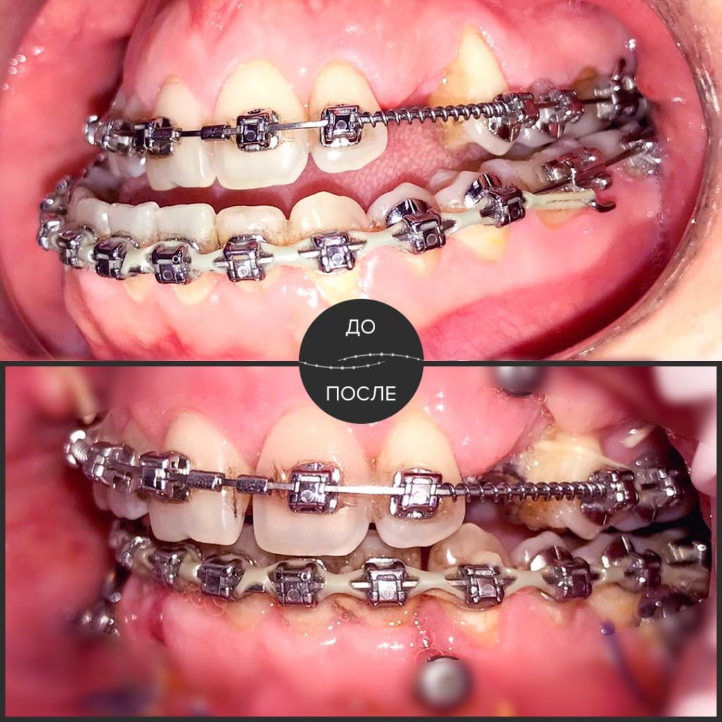 У пациентки сложная зубо-челюстно-лицевая аномалия: мезиальный прикус с обратным перекрытием на фоне сужения верхней челюсти. 