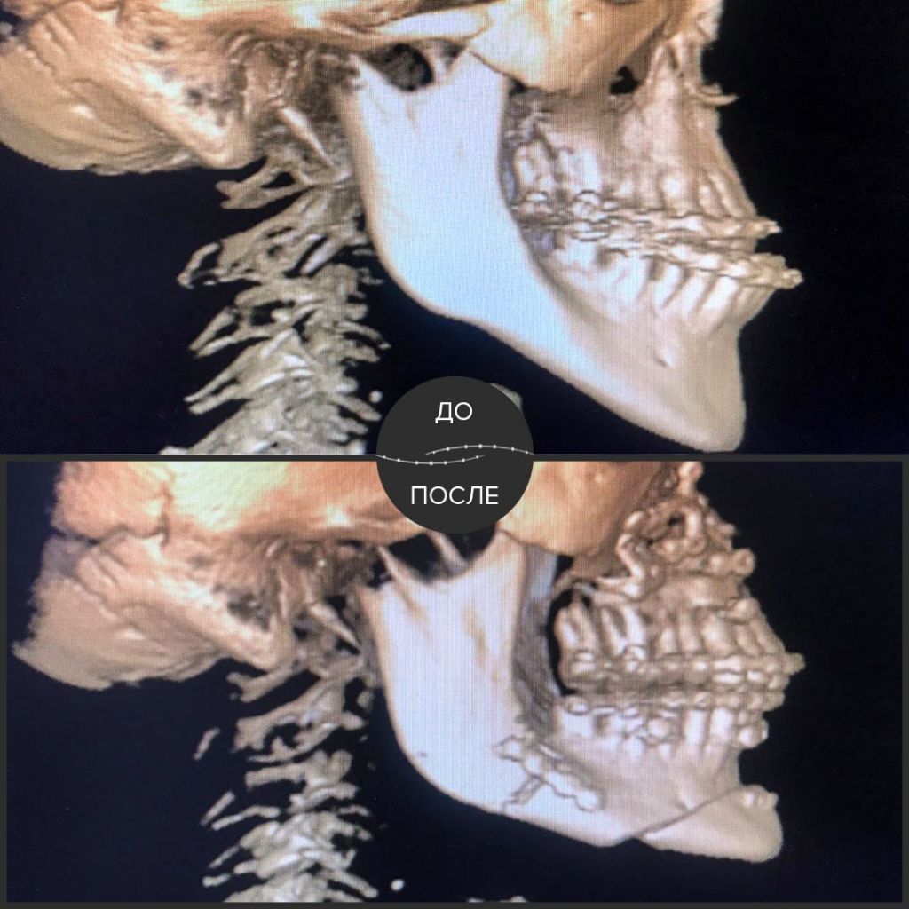 У пациентки сложная зубо-челюстно-лицевая аномалия: мезиальный прикус с обратным перекрытием на фоне сужения верхней челюсти. 
