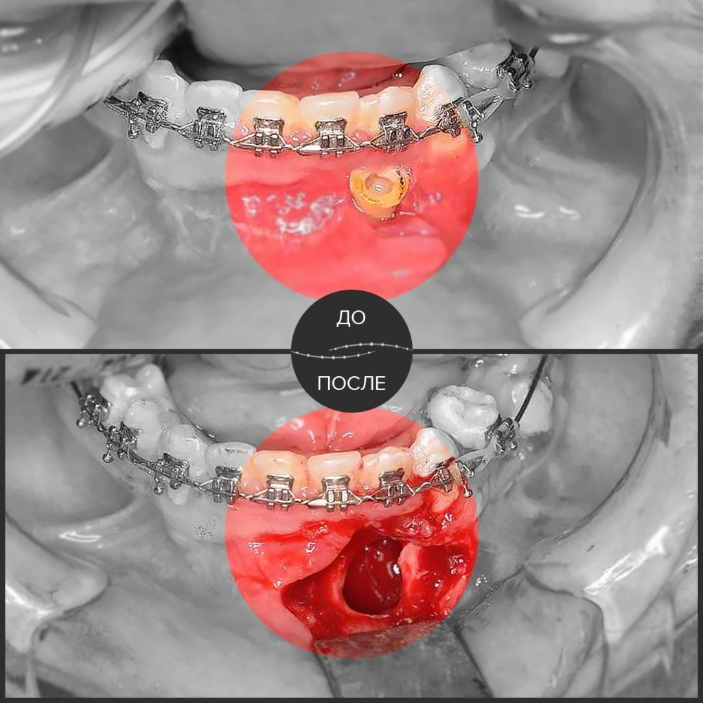У пациента кератокиста подбородочного отдела нижней челюсти. 