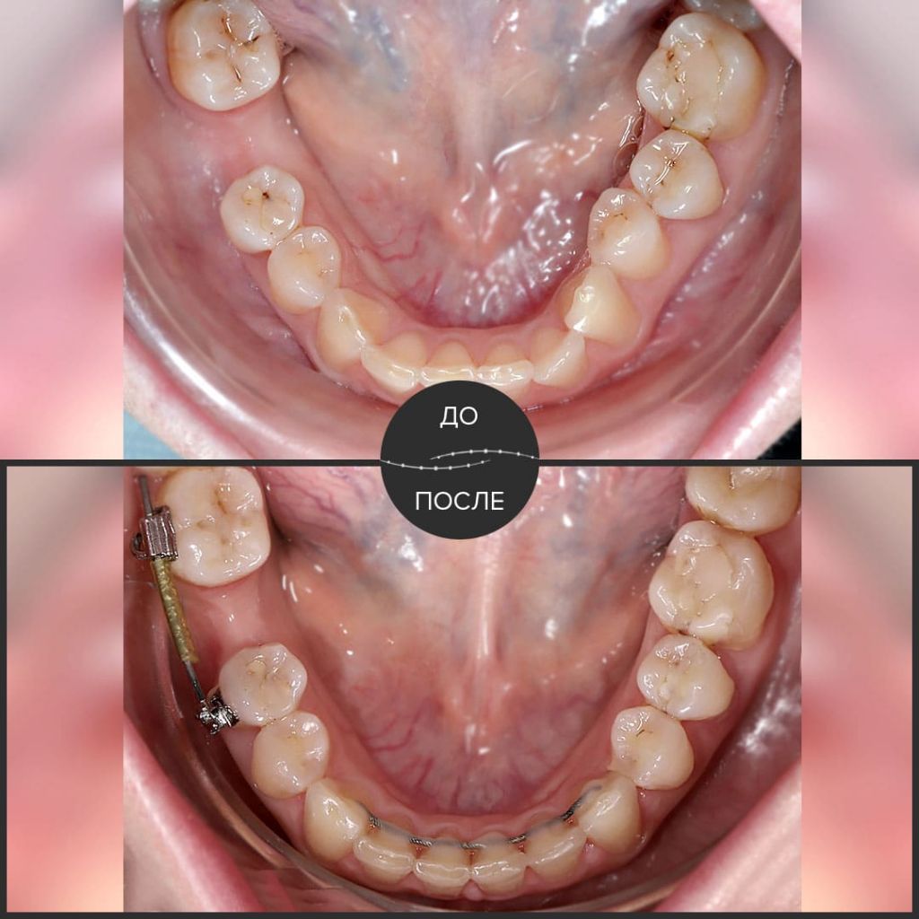 Ортодонтическая подготовка перед протезированием.