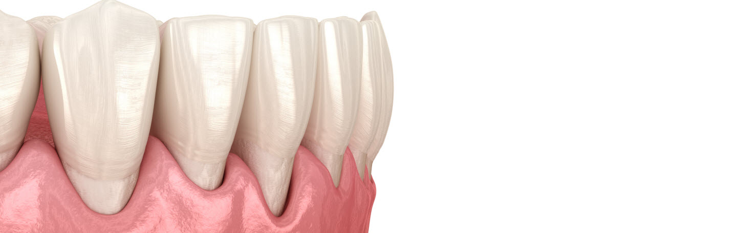 Почему дёсны опускаются и оголяют зубы — и можно ли это остановить