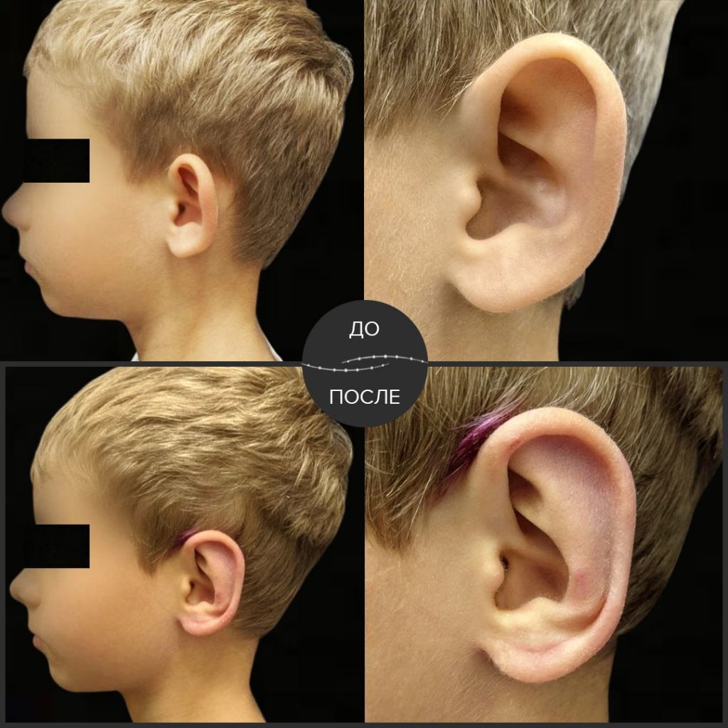 У пациента врождённая двусторонняя деформация ушных раковин — лопоухость. 