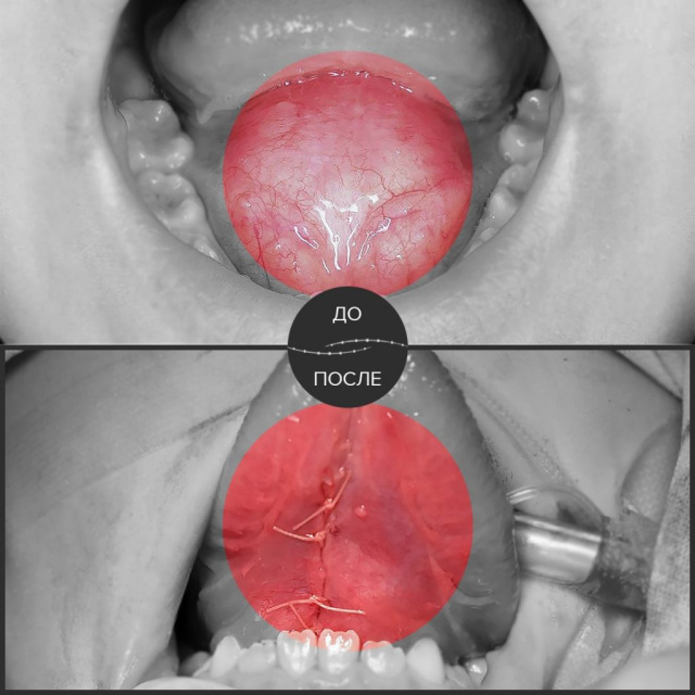 У пациента дермоидная киста дна рта. 