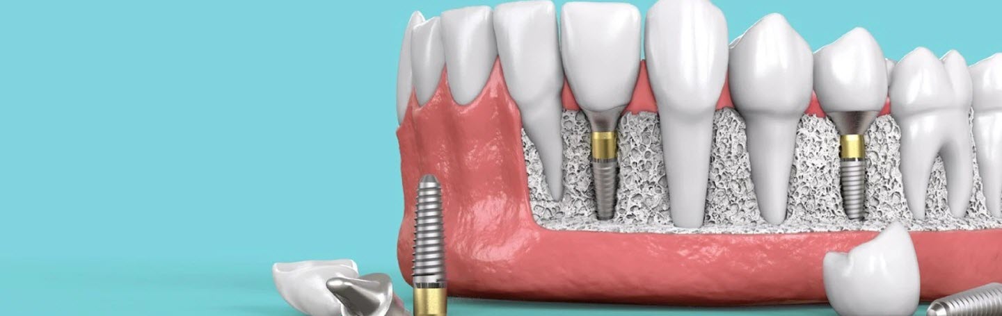 Имплантация зубов: что скрывается за идеальными результатами? Риски и мифы, о которых молчат