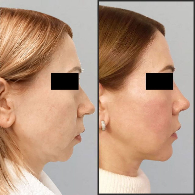 Улучшение эстетики носа и нижней трети лица пластической хирургией.
