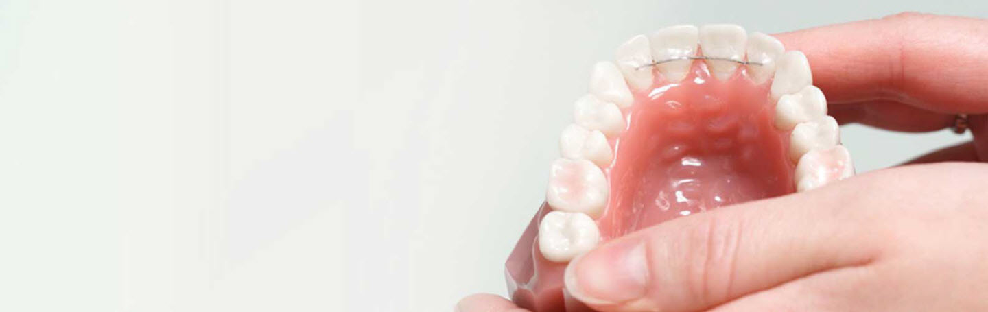 Сняли брекеты? Почему без ретейнера ваша улыбка может не продержаться и года