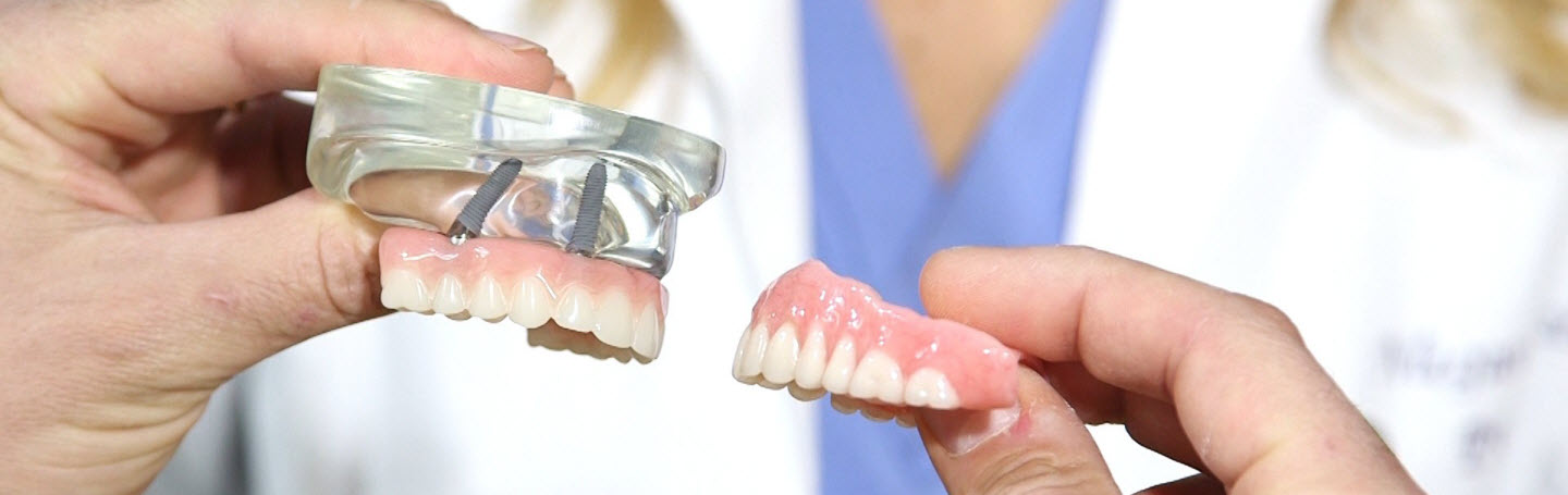 Имплантаты или протезы: что выбрать и когда? Честное сравнение без запугивания и мифов