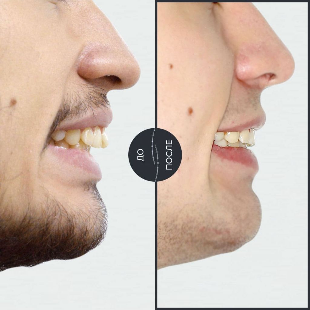 Лечение смещение средней линии при перекрестном прикусе с сужением верхней челюсти.