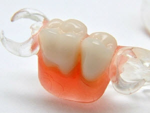 Съемный протез-бабочка