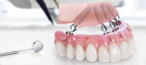 Метод all-on-4 в имплантации зубов